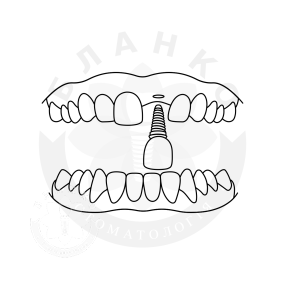 Имплантация переднего зуба ( зона улыбки ) без костной пластики Имплантация переднего зуба ( зона улыбки ) без костной пластики