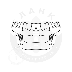 Установка двух имплантов «под ключ» при полном отсутствии зубов Установка двух имплантов «под ключ» при полном отсутствии зубов