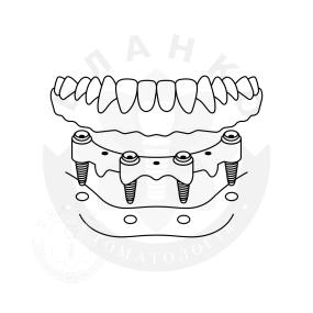Установка четырёх имплантов «под ключ» при полном отуствии зубов + несъемная ортопедическая конструкция, балочная фиксация Установка четырёх имплантов «под ключ» при полном отуствии зубов + несъемная ортопедическая конструкция, балочная фиксация