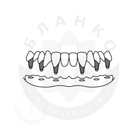 Установка шести имплантов «под ключ» при полном отуствии зубов + несъемная конструкция «оксид циркония» Установка шести имплантов «под ключ» при полном отуствии зубов + несъемная конструкция «оксид циркония»