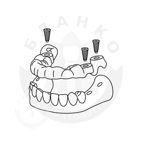 Хирургические шаблоны Хирургические шаблоны